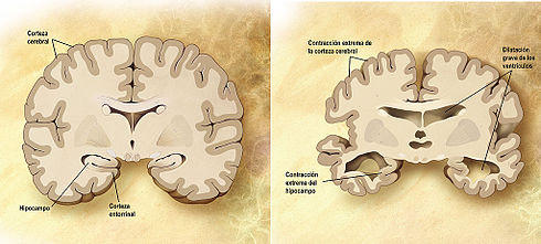 Cerebro sano y cerebro dañado por el Alzheimer