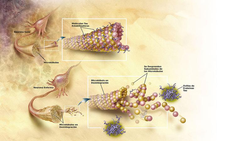 Neurona dañada con ovillos de proteína tau