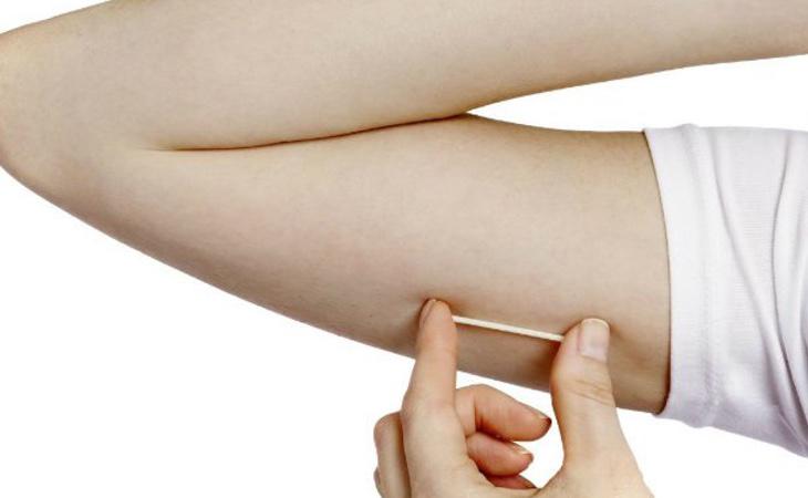 Un implante anticonceptivo del brazo