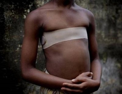 Planchado de senos: la otra mutilación femenina que asoma en Europa
