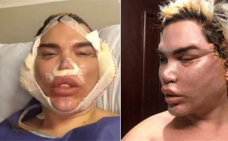 El rostro de Rodrigo Alves se muestra irreconocible tras la operación