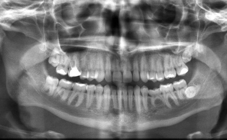 La periodontitis podría ser la causa del Alzheimer