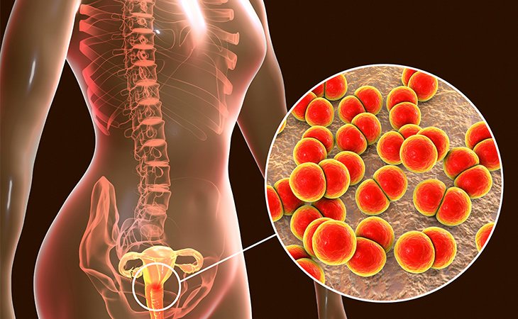 La cepa de neisseria gonorrhoeae es resistente a los fármacos comunes