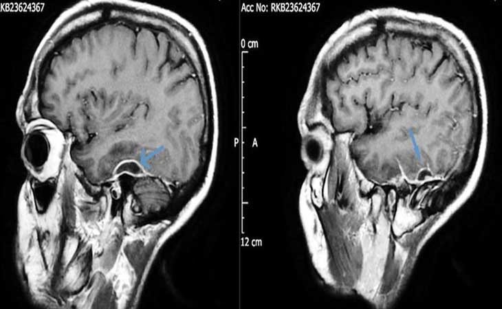 Cerebro del joven