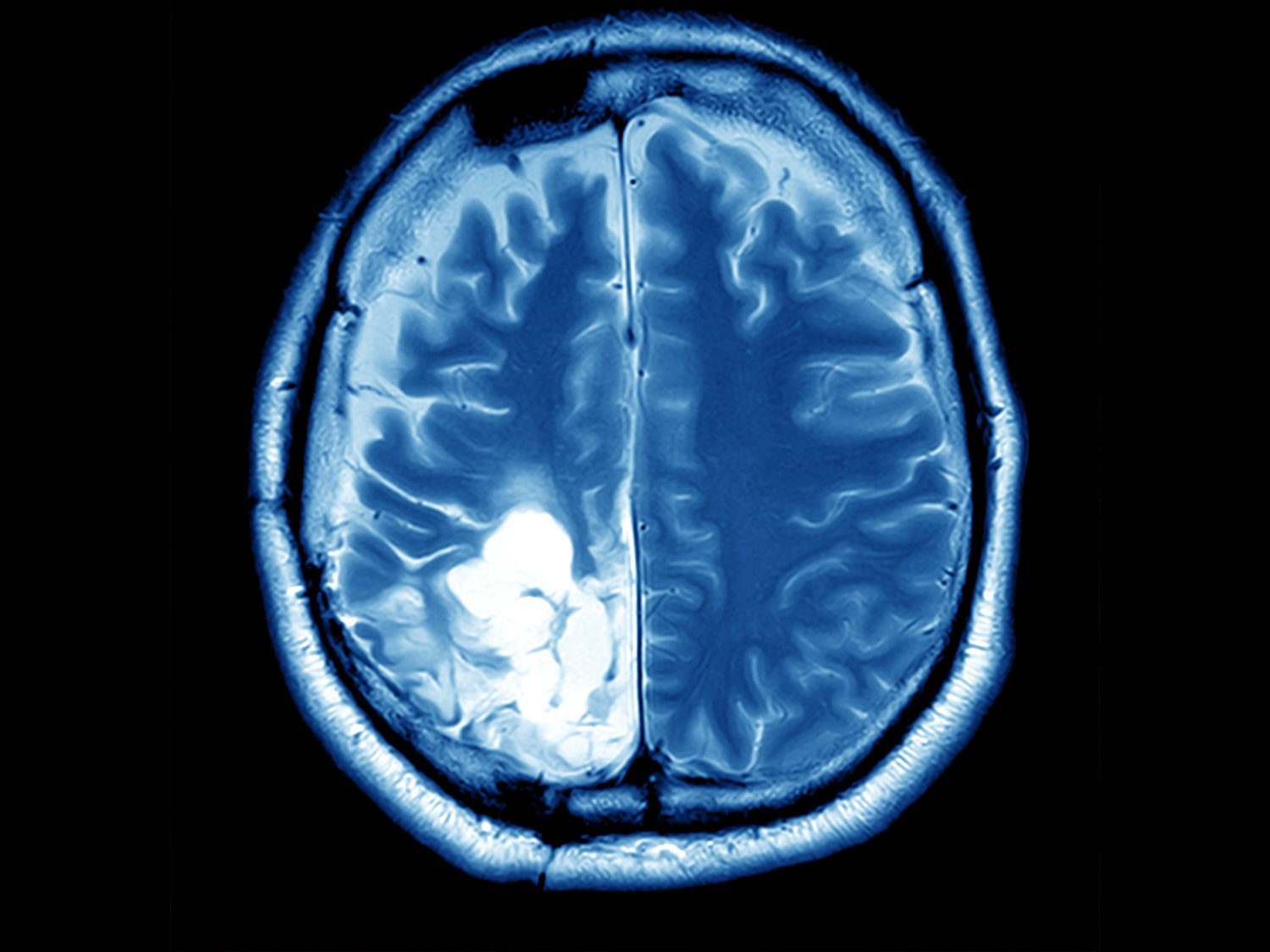 A punto de morir con el cerebro lleno de pus con una infección producida por bastoncillos