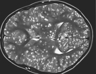 Muere con 18 años con el cerebro lleno de larvas tras comer carne cruda