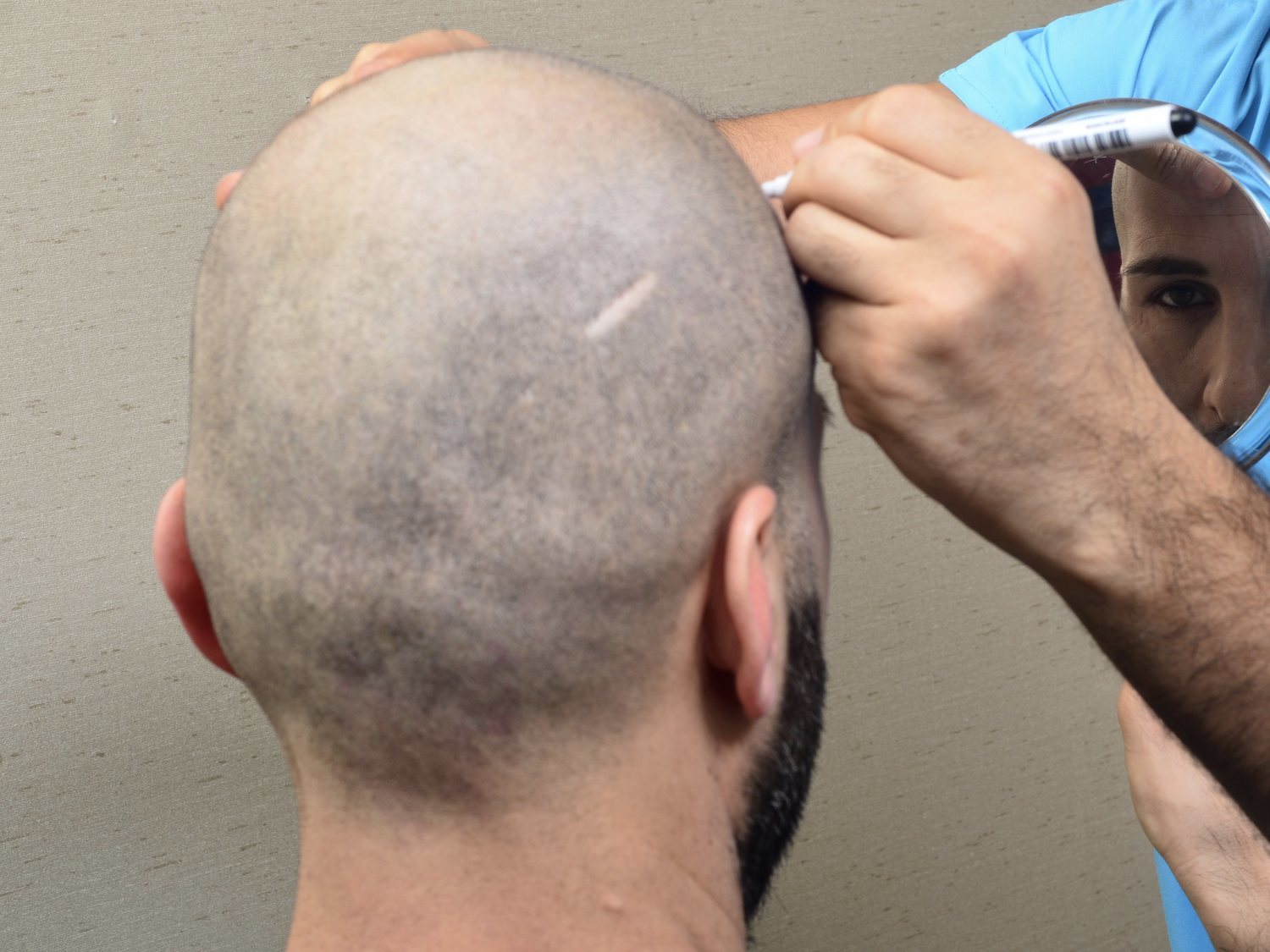 Muere con 39 años tras un implante de pelo en una prestigiosa clínica de Bilbao