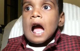 Extraen 526 dientes a un niño a causa de un tumor benigno