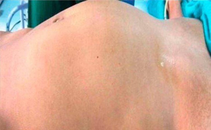 Fotografía captada por los médicos sobre el bulto abdominal que presentaba la paciente