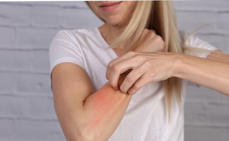 Los sarpullidos y alergias son un síntoma frecuente