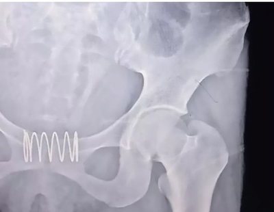 Una mujer se inserta un muelle metálico en la vagina para que actuase como anticonceptivo