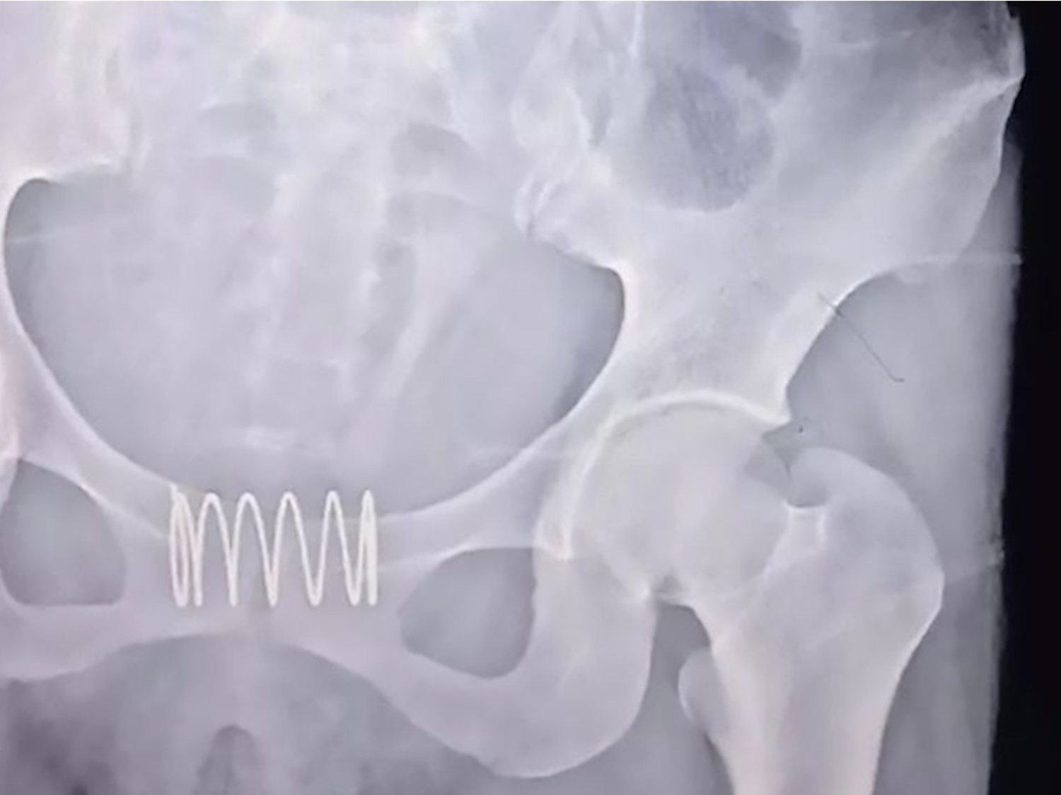 Una mujer se inserta un muelle metálico en la vagina para que actuase como anticonceptivo