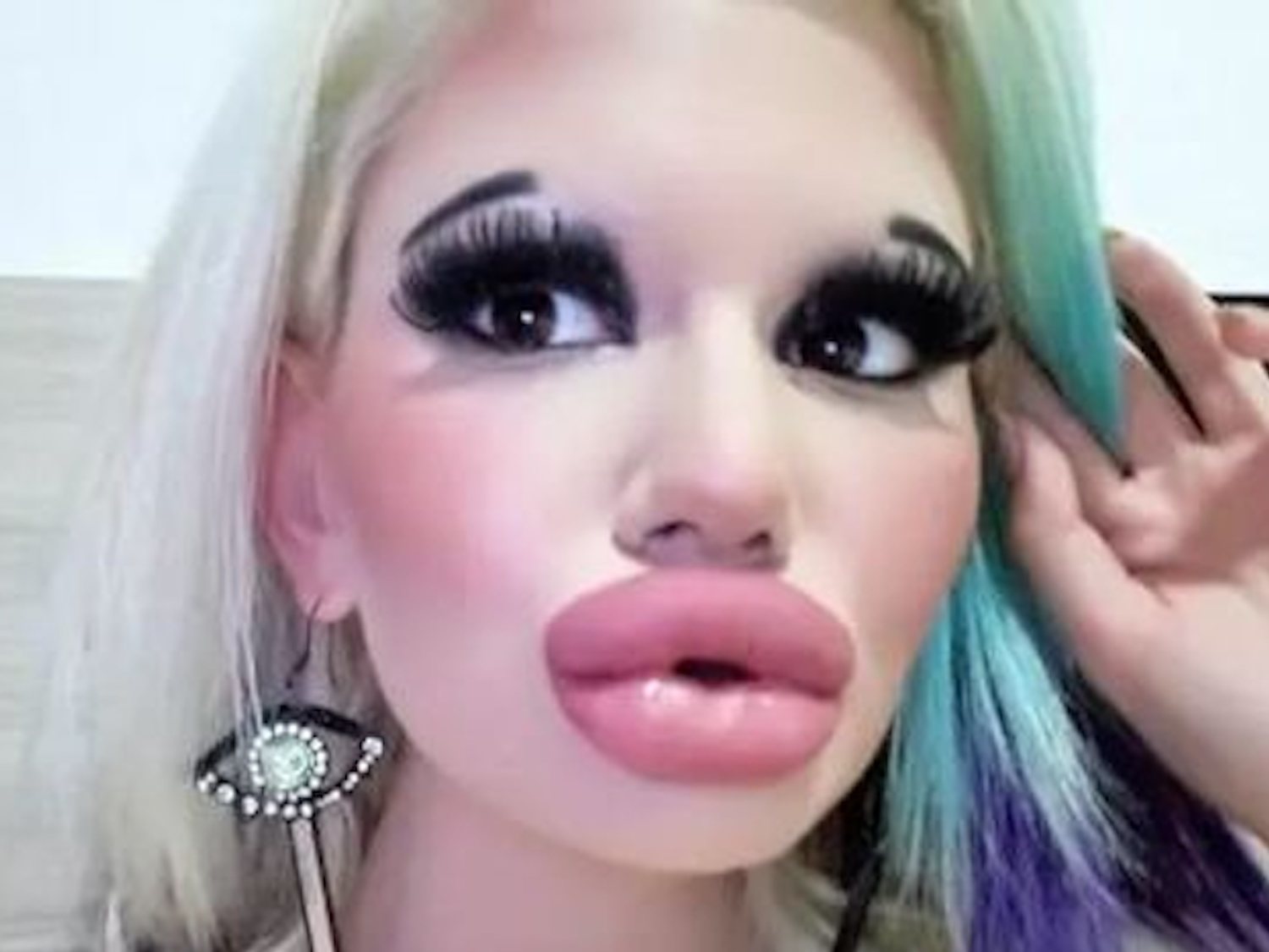 Una mujer triplica el tamaño de sus labios tras operarse quince veces