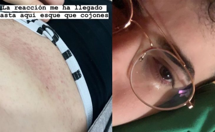 Edgar Aragall compartió en sus redes sociales las consecuencias de la agresión con gas pimienta