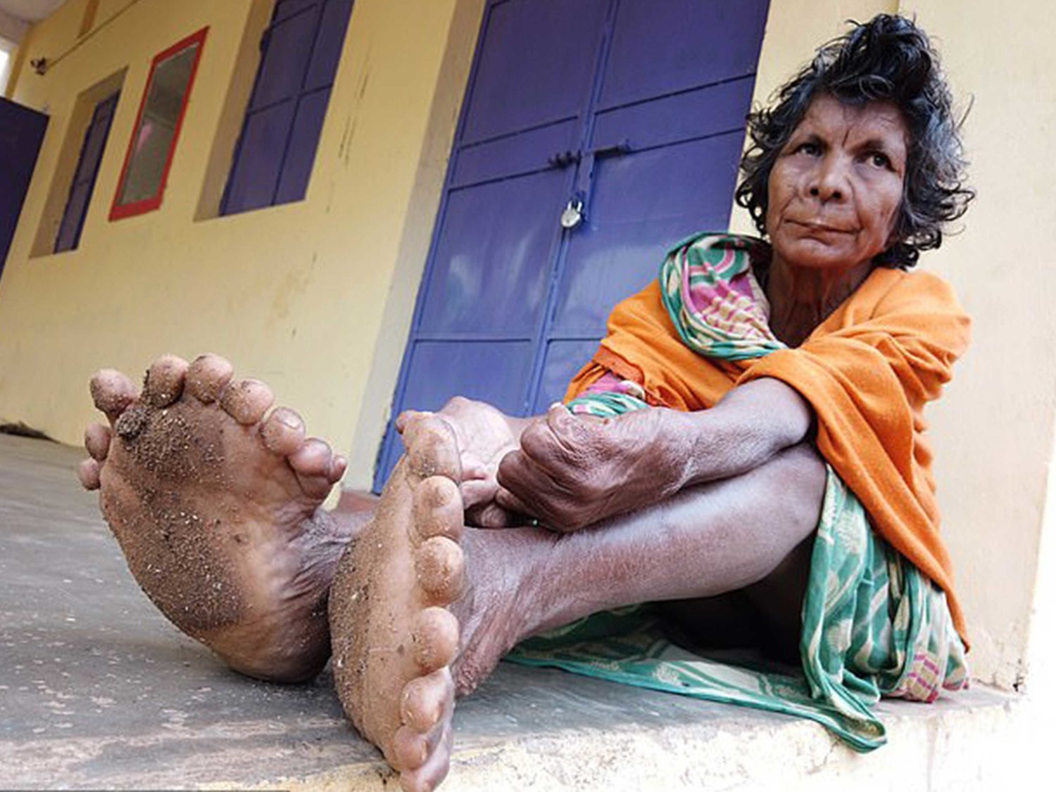La mujer india con 31 dedos en los pies y 9 en la mano consigue nuevo récord mundial
