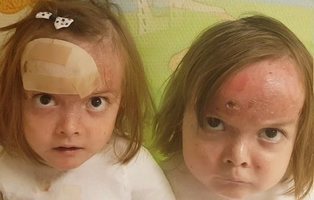 Las gemelas con piel de mariposa que llevan meses en el hospital: "¿Y vosotros os quejáis?"