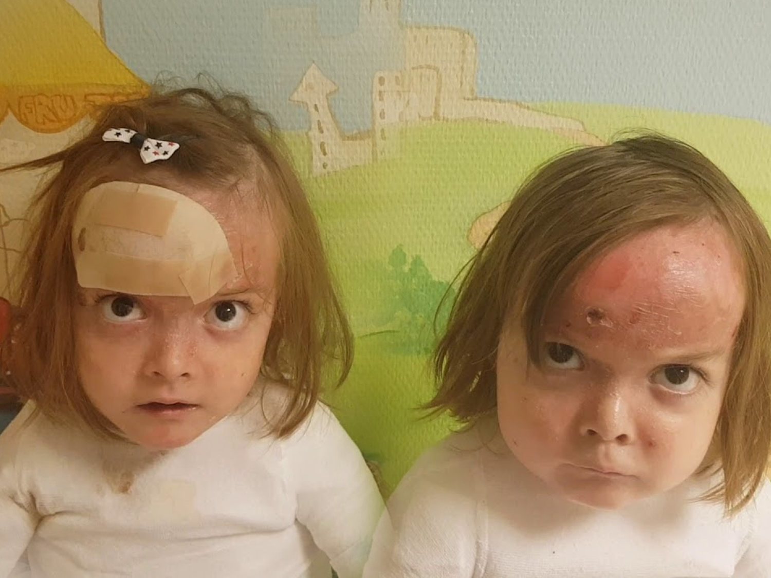 Las gemelas con piel de mariposa que llevan meses en el hospital: "¿Y vosotros os quejáis?"