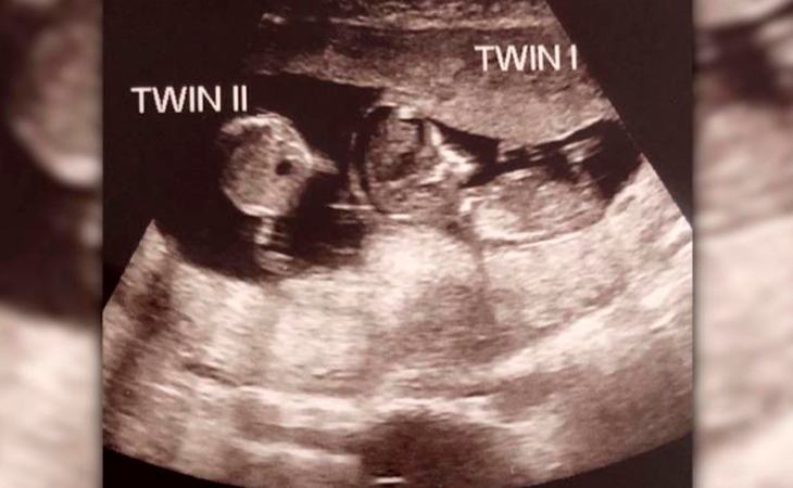 La ecografía mostraba dos bebés. Foto: CNN