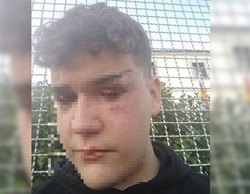 Brutal agresión homófoba en Galicia: "Me preguntaron si era gay y me pegaron puñetazos en el ojo y la cabeza"