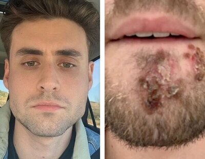A punto de morir por la bacteria 'comecarne' tras utilizar accidentalmente la afeitadora de su amigo
