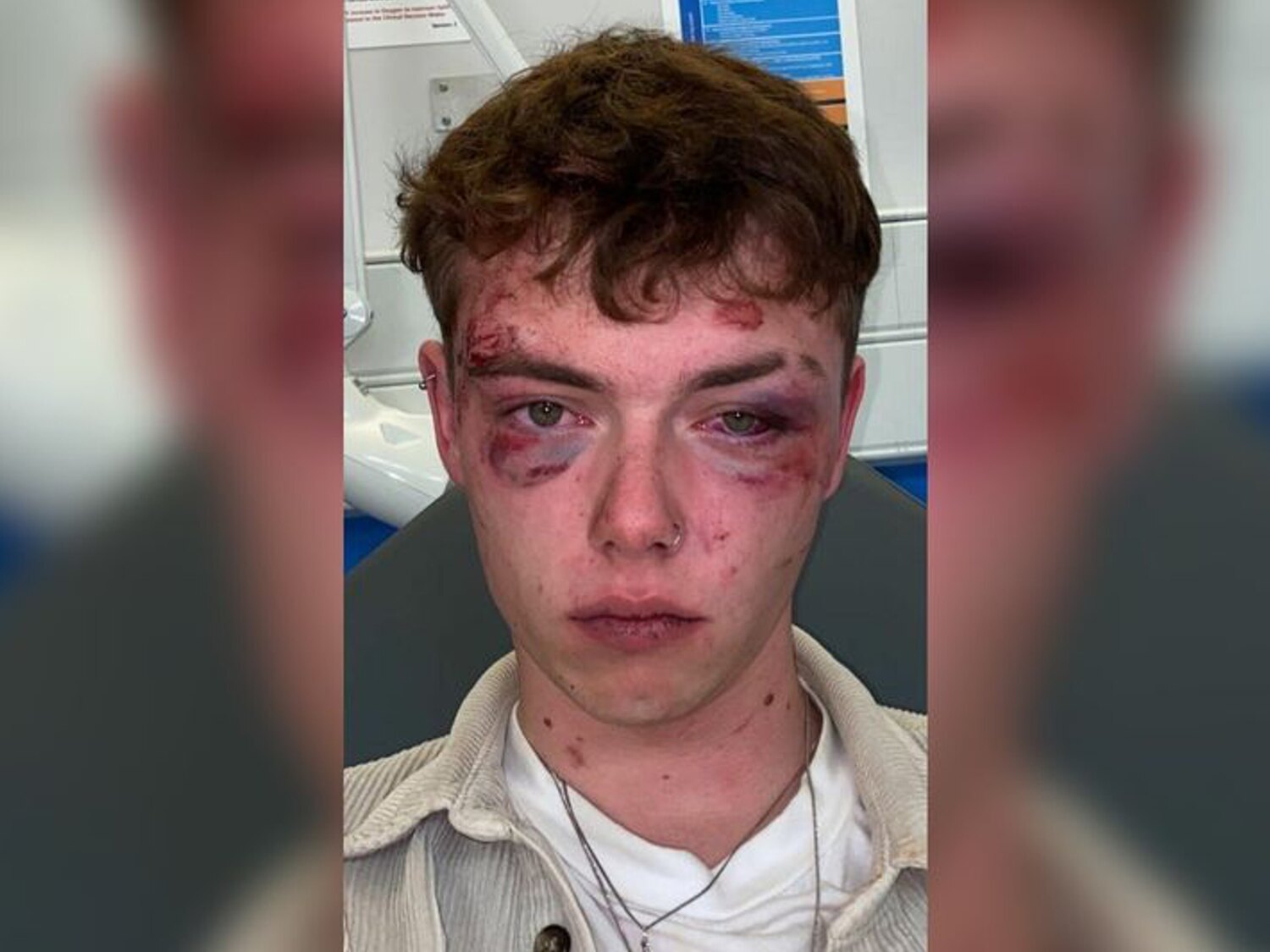 Bifobia: Brutal agresión a un joven bisexual de 19 años dejándole la cara destrozada