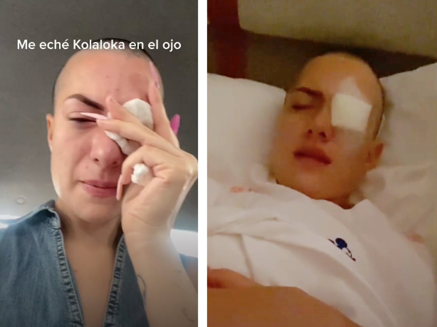 Una influencer confunde las gotas para sus ojos con pegamento y se pega el párpado