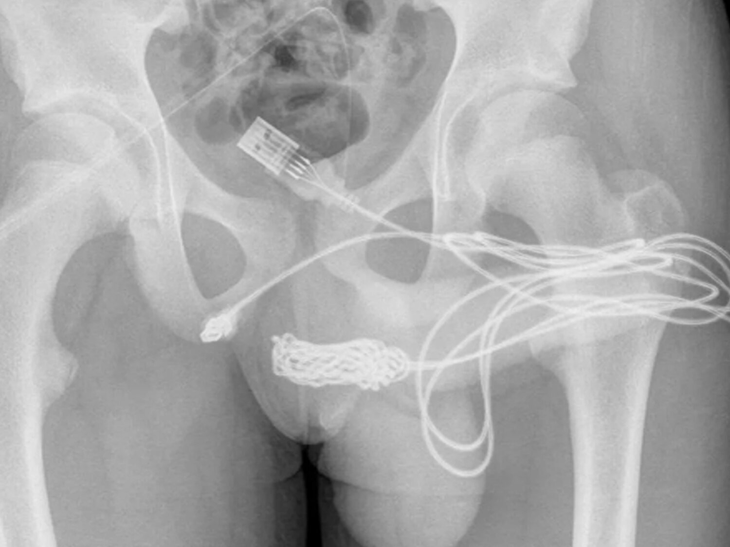 Un joven de 15 años, intervenido de urgencia por introducirse un cable USB para medir el interior de su pene