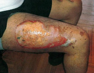 Sufre gravísimas quemaduras en la mano y en la pierna tras explotarle un cigarrillo electrónico