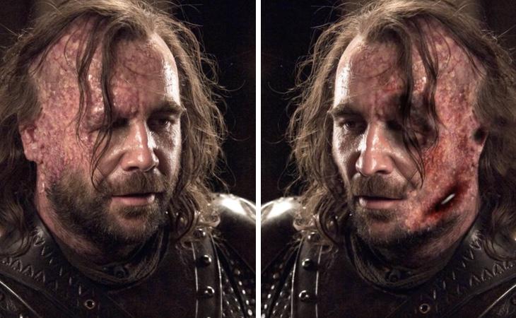 Sandor Clegane tiene la cara aún más destrozada en los libros