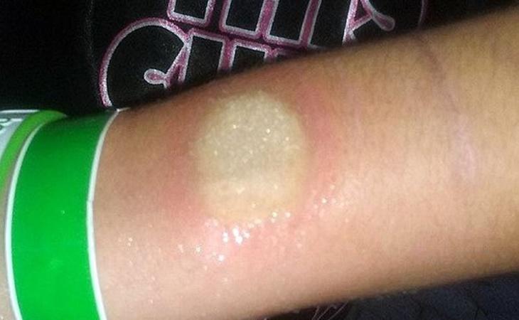 Las lesiones que provoca el agua congelada sobre la piel se agravan por el efecto de la sal