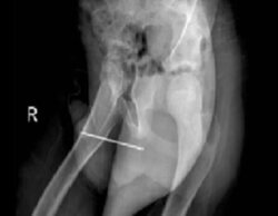 Se inserta una aguja de coser en el pene, se le atasca en la uretra y termina ingresado en el hospital