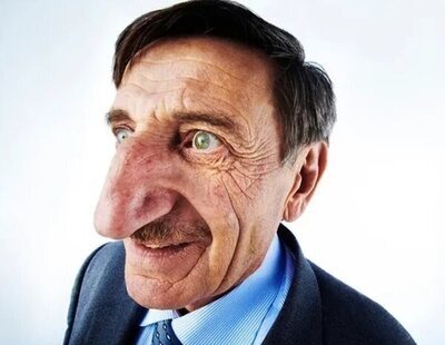 Este es el hombre con la nariz más larga del mundo: le mide 9 centímetros