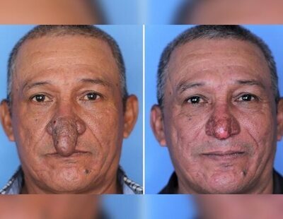 La operación que ha cambiado la vida a un hombre con la nariz completamente deformada