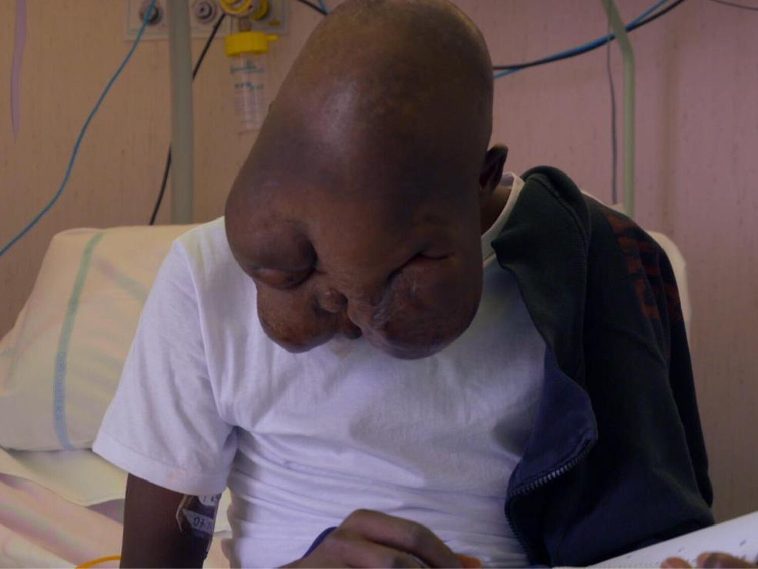 El joven al que su madre abandonó por un tumor en la cara, recompuso su vida y ha encontrado la cura