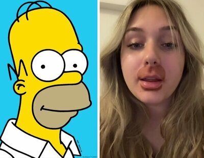 Se gasta 700 euros en un tratamiento de labios y termina con la 'cara de Homer Simpson'