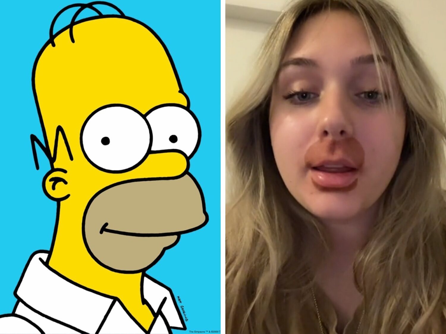 Se gasta 700 euros en un tratamiento de labios y termina con la 'cara de Homer Simpson'