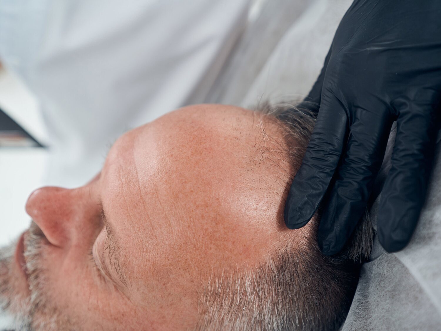 Aprobado el primer fármaco para tratar la calvicie que restaura el pelo en meses
