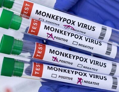 España registra la segunda muerte por viruela del mono