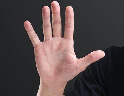 Un estudio observa un vínculo entre la asimetría de los dedos de las manos y la gravedad del Covid