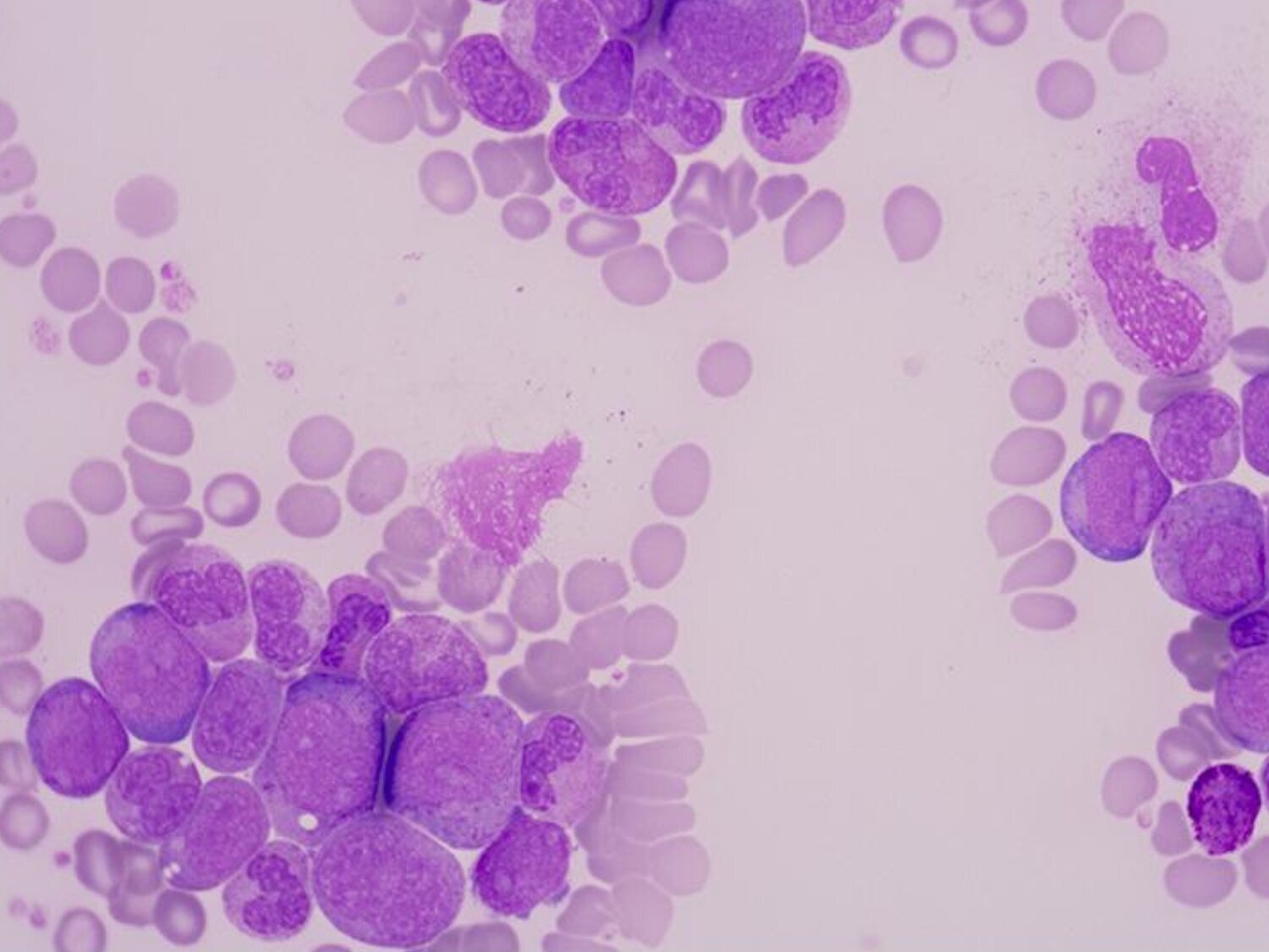 Un medicamento experimental ha logrado curar la leucemia avanzada en 18 pacientes