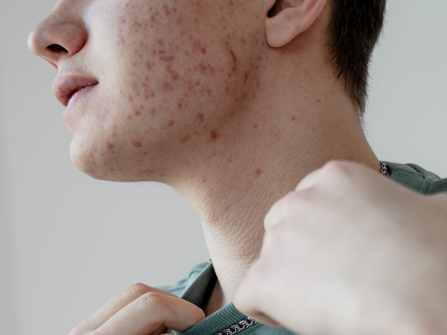 Roacután: efectos secundarios de uno de los medicamentos más eficaces para tratar el acné