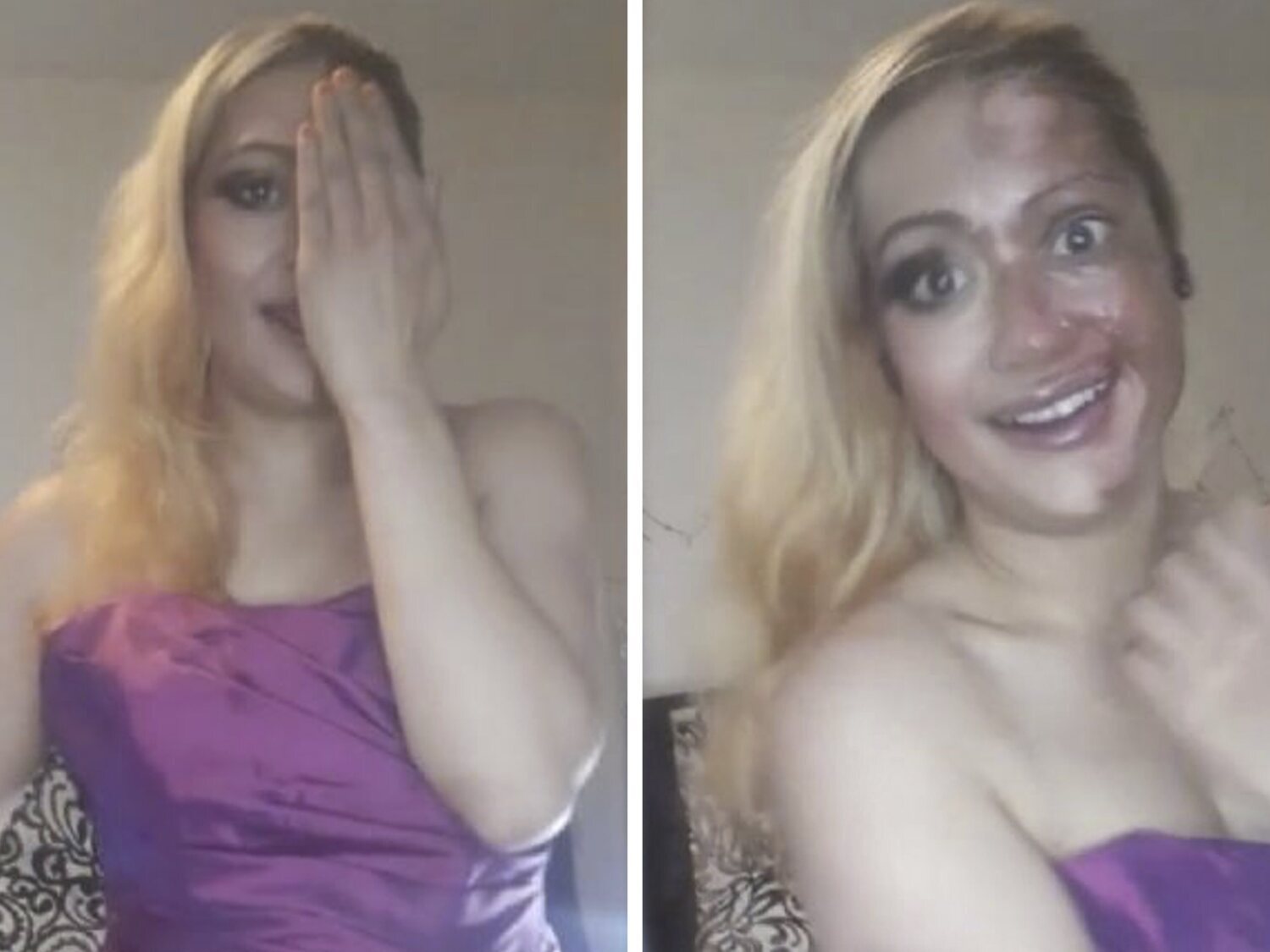 El reto viral de TikTok que ha dejado a una mujer con quemaduras en la mitad del rostro