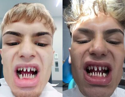 Un modelo se gasta miles de euros en una operación de dientes y se queja de "parecer un tiburón"
