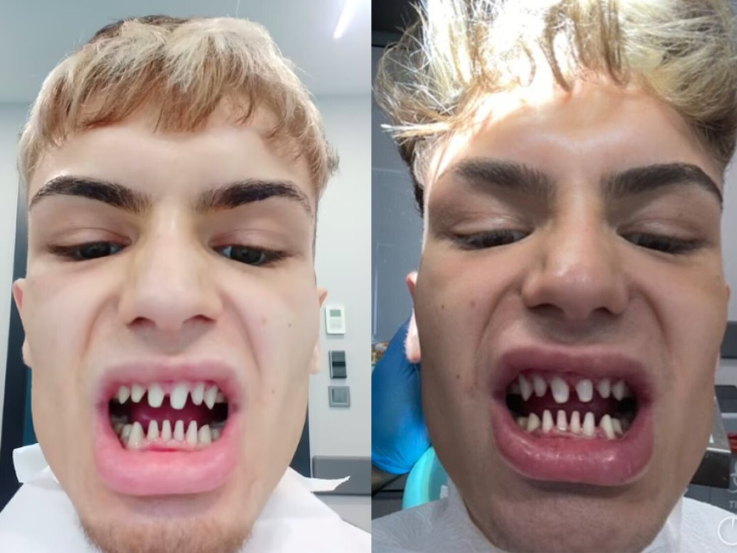 Un modelo se gasta miles de euros en una operación de dientes y se queja de "parecer un tiburón"