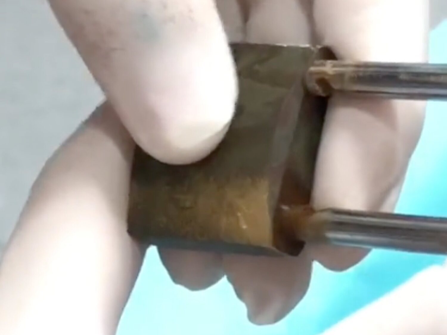 Un joven permanece con un candado incrustado en el pene durante meses porque su novia tenía las llaves