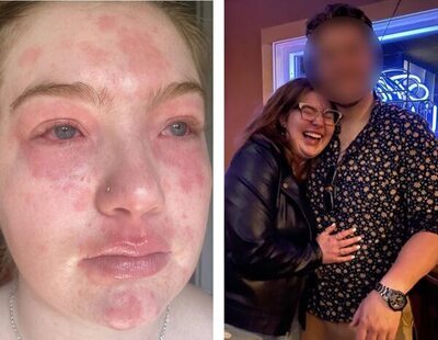 "Soy alérgica a mi novio": la erupción que sufre una joven al pasar tiempo con su pareja
