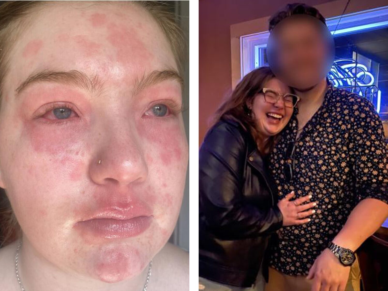 "Soy alérgica a mi novio": la erupción que sufre una joven al pasar tiempo con su pareja