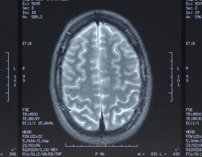 Extraen un gusano vivo de 8 centímetros del cerebro de una mujer