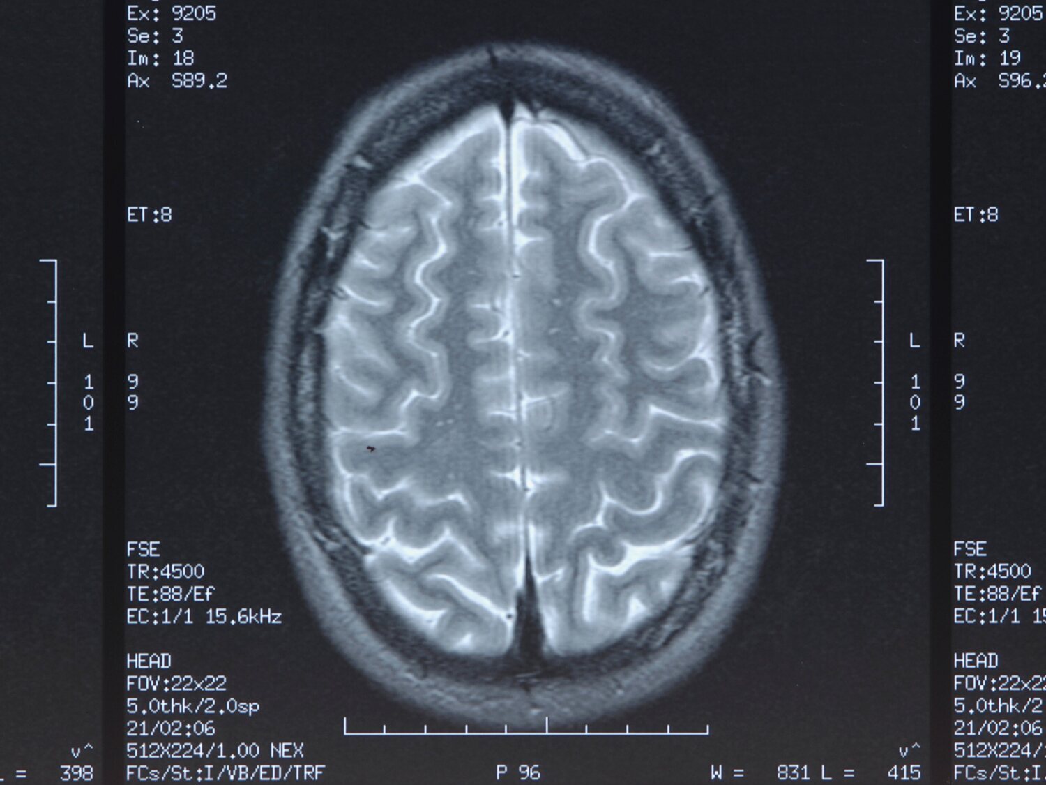 Extraen un gusano vivo de 8 centímetros del cerebro de una mujer