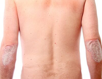 Psoriasis: qué es, sus complicaciones para la salud de la piel y tratamiento